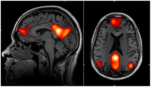 Beynin varsayılan ağ modunu gösteren fMRI taraması. ohn Graner, National Intrepid Center of Excellence, Walter Reed National Military Medical Center, Bethesda, MD.